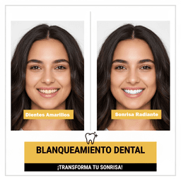 Blanqueamiento Dental: Métodos, Riesgos y Resultados